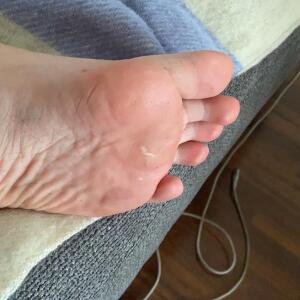 Pieds_dapolline mym